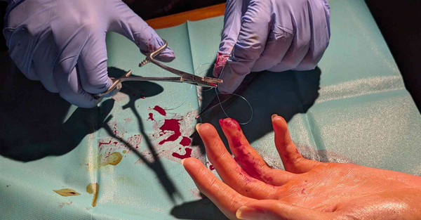 Magnet procedure guide
